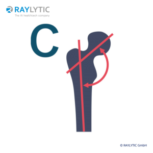 Caput-collum-diaphyseal (CCD) angle - Pelvic