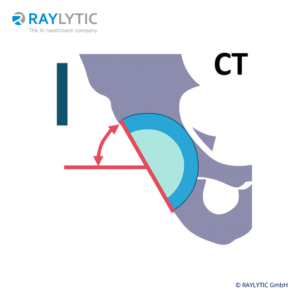 CT analysis of cup inclination or anteversion - Pelvic parameters