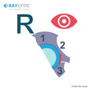 Evaluation of radiolucency around the cup in accordance to zones of delee and charnley - Pelvic parameters
