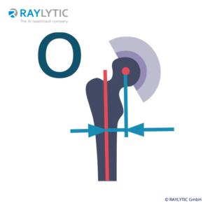 Femoral offset - Pelvic parameters