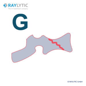 Genant fracture classification - Spinal parameters
