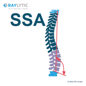 Spino-sacral angle (SSA) - Spinal parameters