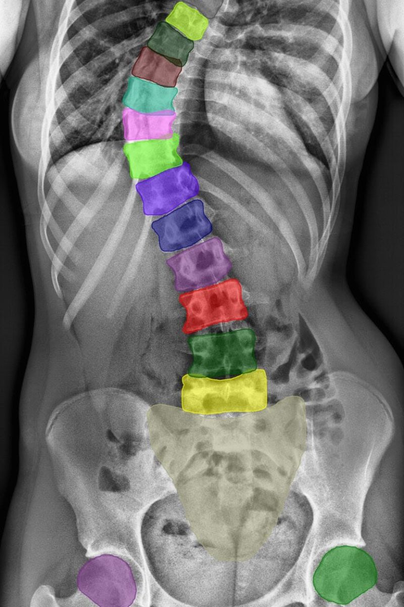 Automated scoliosis analysis_RAY Logo
